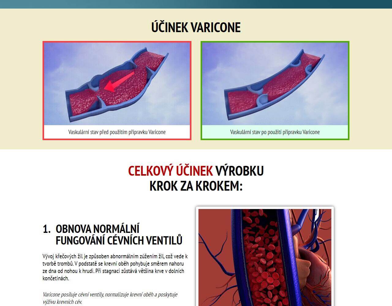 Varicone 5